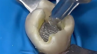 ترمیم غیر همرنگ دندان