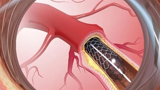 مراقبت های بعد از آنژیوپلاستی