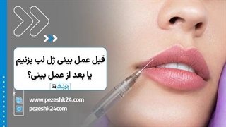 ژل لب قبل یا بعد از عمل بینی؟ چند وقت بعد عمل بینی میتوان ژل لب تزریق کرد؟