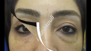 تکنیک مدرن بلفاروپلاستی پایین با پخش چربی و همراه با کانتوپکسی