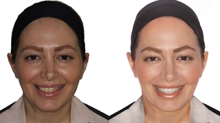 ارتودنسی دیپ بایت ناقرینه | دکتر داودیان