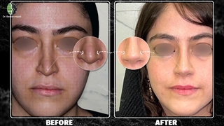 جراحی بینی ثانویه یا عمل بینی ترمیمی