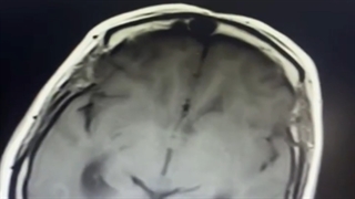 عمل جراحی کیست کلویید بطن سوم و هیدروسفالی شدید