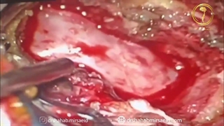 انتشار سرطان سینه به ستون فقرات گردن