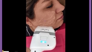 تصاویر هایفو تراپی صورت