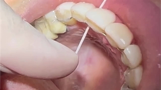 نخ دندان کشیدن با فیکس ریتینر