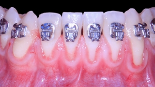 جراحی لثه چیست؟ | خطر‌هایی که بیمار را تهدید می‌کند | سیمادنت