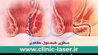 فیستول چیست؟ روش درمان آسان فیستول