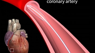 بالن آنژیوپلاستی ....