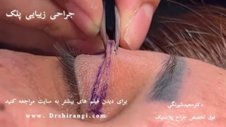 فیلم کامل جراحی پلک در مطب دکتر سعید شیرنگی