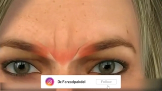 تاثیر بوتاکس