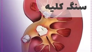 درمان سنگ کلیه