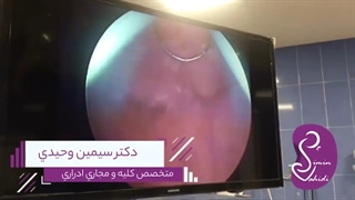 تومور مثانه