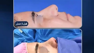 بلافاصله بعد از جراحی زیبایی بینی
