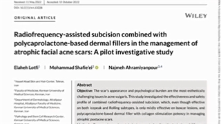 از بین بردن اسکار آکنه با دستگاه پزشکی ENDO-RF Subcision
