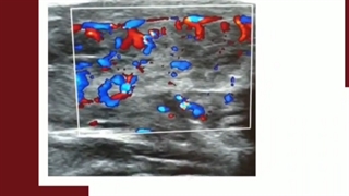 سونوگرافی کالر داپلر غده ی تیروئید