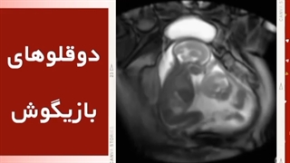 دوقلوهای بازیگوش در رحم مادر