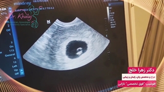 بارداری به روش IUI